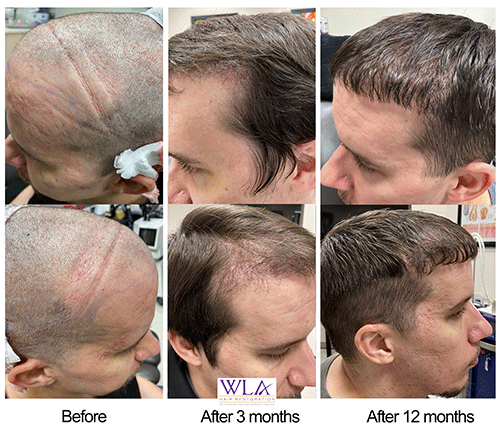 ARTAS iX assisted FUE over 12 months. Dr. Melamed West LA Hair Restoration