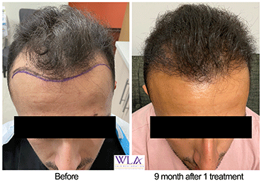 Before and After 9 month FUE ARTAS iX hair restoration procedure by Dr. Melamed at West LA Hair Restoration