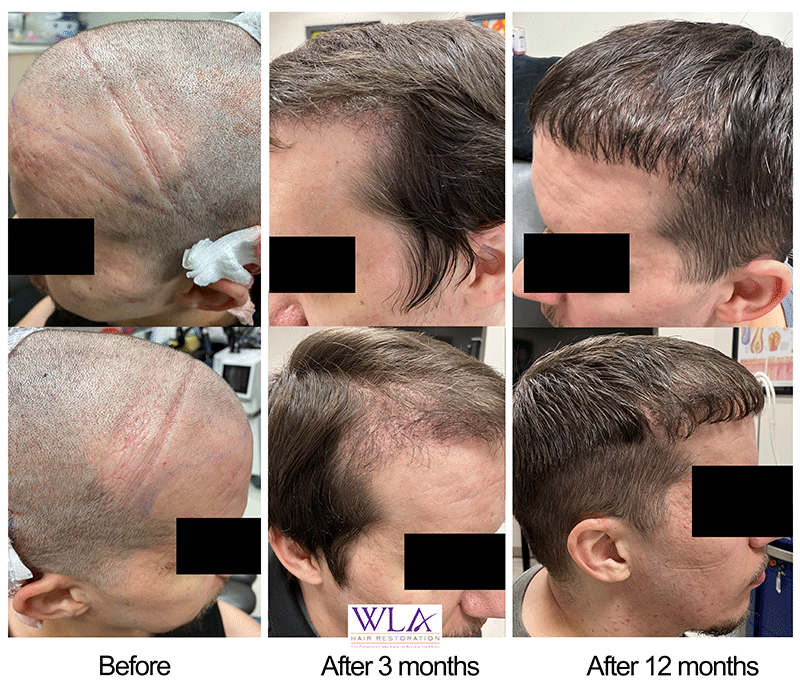 ARTAS iX assisted FUE over 12 months. Dr. Melamed West LA Hair Restoration