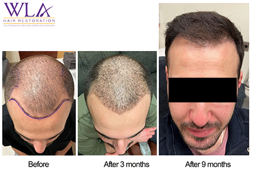 ARTAS iX assisted FUE over 9 months. Dr. Melamed West LA Hair Restoration